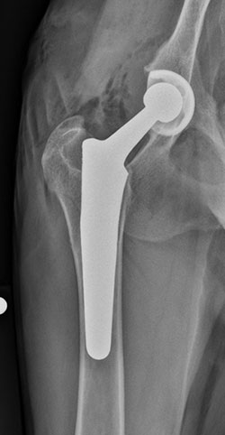 Hip Replacement X-ray